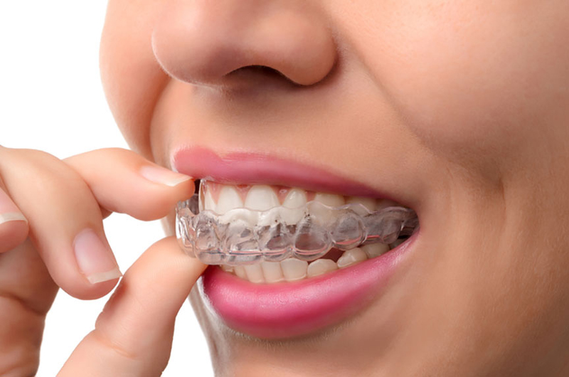 Invisalign clear aligners