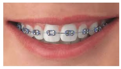 Girl in braces Dr. Anuradha Rajkuwar : Smayana Advance Dental Clinic, Delhi